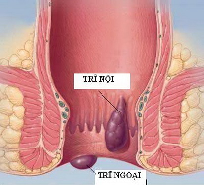 Cả trĩ nội và ngoại đều ảnh hưởng nhiều đến cuộc sống của người bệnh.