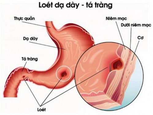 Viêm loét dạ dày tá tràng là chứng bệnh thường gặp, gây nhiều phiền phức cho người bệnh.