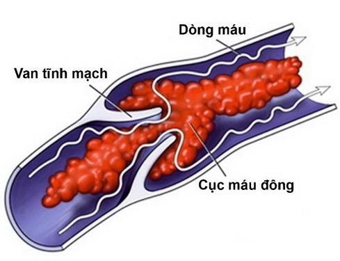 Khi dùng thuốc trị loãng xương, cần lưu ý tình trạng viêm tĩnh mạch huyết khối.