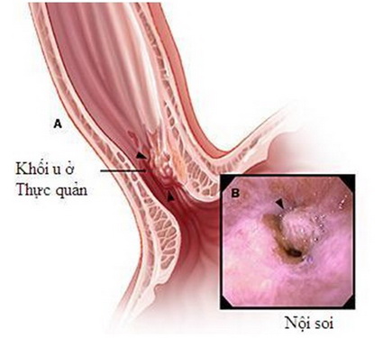 Hình ảnh nội soi khối u thực quản.