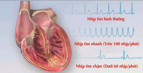 Nguy cơ rối loạn nhịp tim khi dùng thuốc chữa liệt dạ dày.