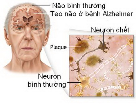 Não bình thường và não ở bệnh nhân SSTT.