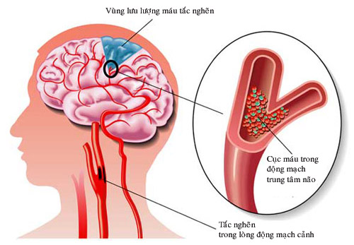 Lưu lượng máu ở não bị tắc nghẽn là một nguyên nhân gây thiểu năng tuần hoàn não.