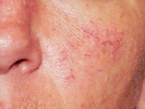 Lạm dụng corticoid làm da mỏng và xuất hiện mạch máu rõ dưới da.