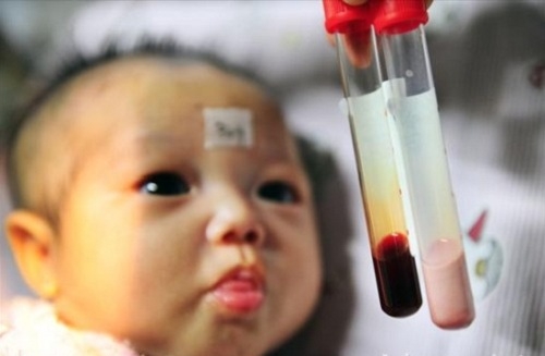 Trẻ bị tan huyết bẩm sinh có máu bị thiếu hồng cầu (ảnh minh họa).