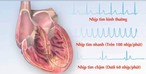 Các biến đổi về cấu trúc tim ở người cao tuổi có thể gây rối loạn nhịp tim. Các biến đổi về cấu trúc tim ở người cao tuổi có thể gây rối loạn nhịp tim.