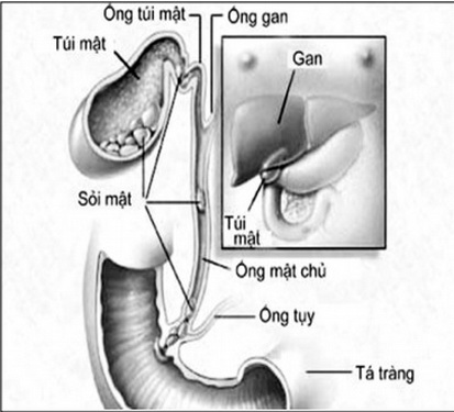 Sỏi mật có thể phát sinh ở các ống dẫn mật trong gan, ở ống mật chủ hoặc ở túi mật.