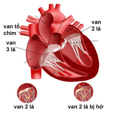 Hở van hai lá.