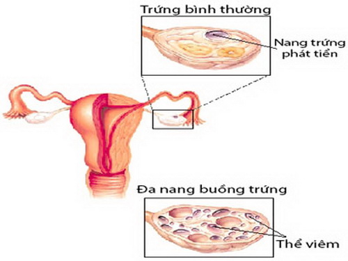 Buồng trứng đa nang dễ gây hiếm muộn.