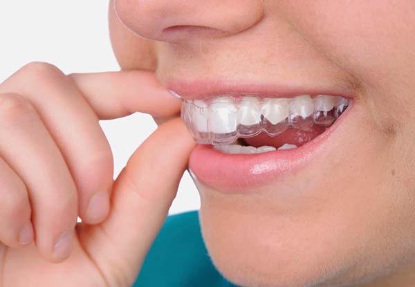 Sử dụng máng dụng cụ chống nghiến răng cho trẻ.