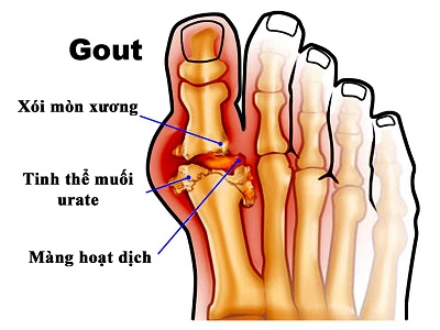 Khi bị bệnh gút, hãy đến các cơ sở y tế chuyên khoa có uy tín để tư vấn điều trị, tránh tiền mất tật mang.