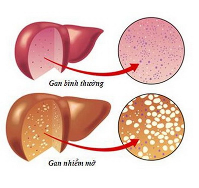 Gan nhiễm mỡ thường ít có dấu hiệu bên ngoài. Gan nhiễm mỡ thường ít có dấu hiệu bên ngoài.