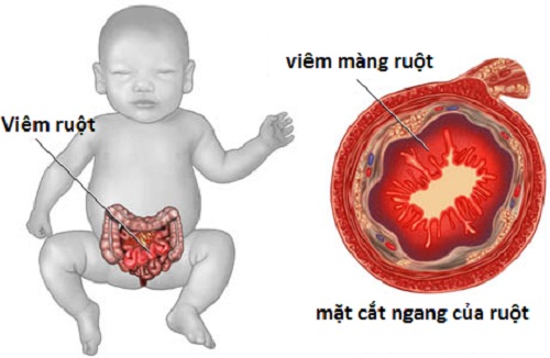 Người mắc bệnh viêm ruột dễ có nguy cơ mắc huyết khối tĩnh mạch. Người mắc bệnh viêm ruột dễ có nguy cơ mắc huyết khối tĩnh mạch.