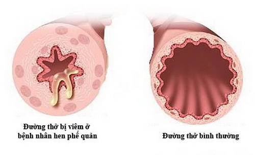 Hen phế quản gây thắt nghẹn đường thở.