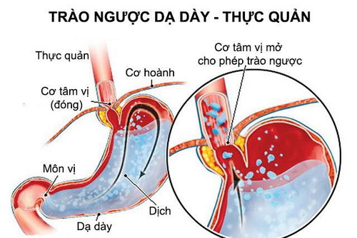 Trào ngược dạ dày thực quản là một nguyên nhân có thể gây cảm giác thắt nghẹt ở cổ họng hay ngực.