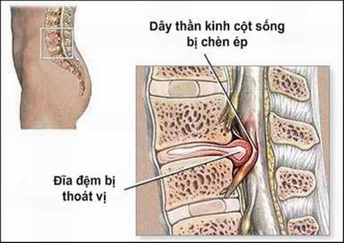 Ngừa biến chứng thoát vị đĩa đệm cột sống thắt lưng