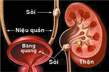 Sỏi thận có thể gây tắc đường tiểu.