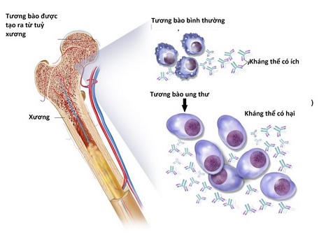 Liệu pháp mới điều trị đa u tủy xương