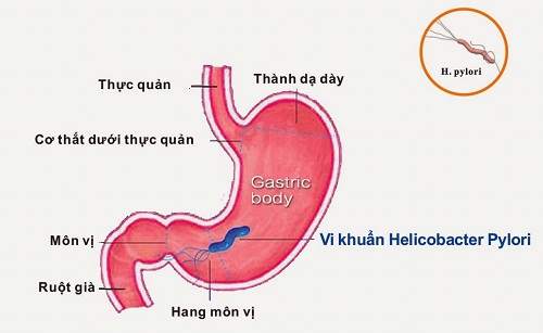 Nhiễm vi khuẩn HP là một trong những nguyên nhân cơ bản mắc viêm dạ dày.