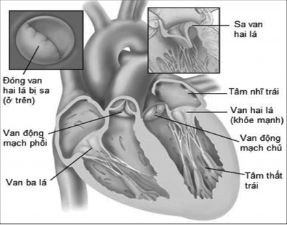 Sa van hai lá là một trong những nguyên nhân gây bệnh van tim.