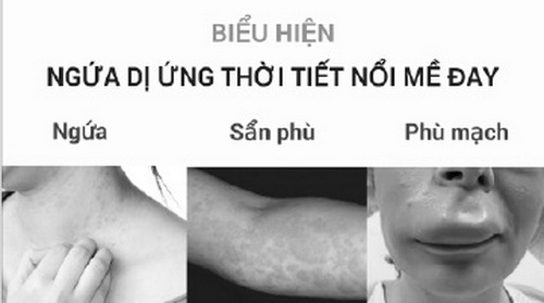 Trời mưa lạnh giá rét, nhiều người dễ bị dị ứng thời tiết nổi mề đay.