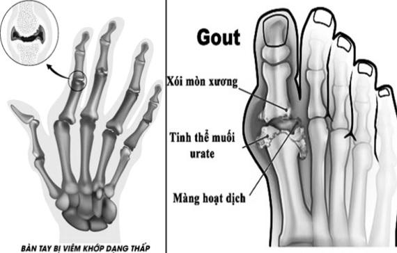 Viêm khớp dạng thấp và bệnh gout dễ mắc trong mùa đông.