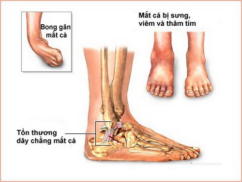 Bong gân mắt cá chân khiến vận động đi lại bị ảnh hưởng trầm trọng.