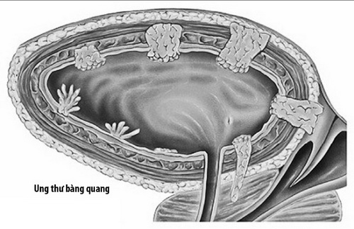 Đau vùng hông thắt lưng có thể là dấu hiệu của ung thư bàng quang.