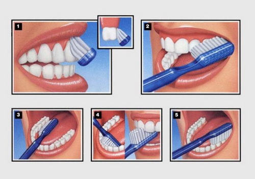 Cần vệ sinh răng đúng cách để phòng bệnh răng miệng.