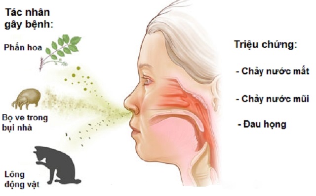 Triệu chứng và các tác nhân gây viêm mũi dị ứng.