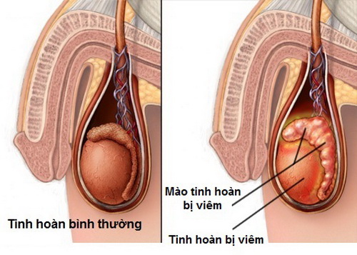 20-35% người mắc bệnh quai bị sau tuổi dậy thì bị biến chứng viêm mào tinh hoàn, có thể dẫn đến vô sinh ở nam giới.