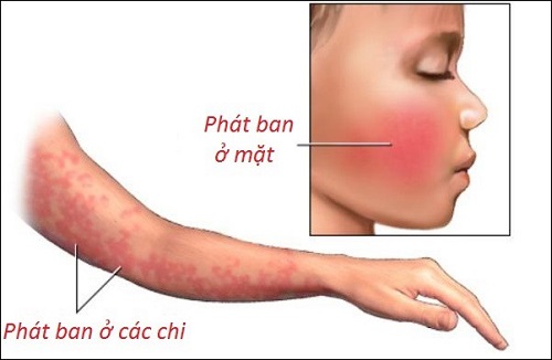 Phát hiện các ban đỏ, cần đưa trẻ đến cơ sở y tế để được các bác sĩ tư vấn.