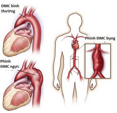 Phình ĐMC là căn bệnh rất nguy hiểm, có tỷ lệ tử vong cao.