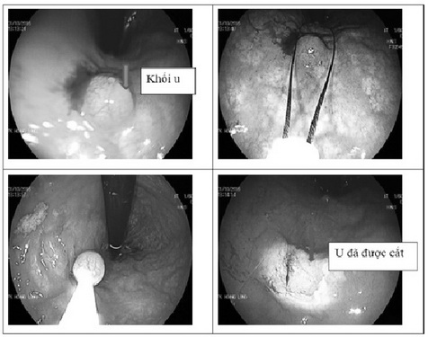 Hình ảnh u carcinoid dưới niêm mạc trực tràng.