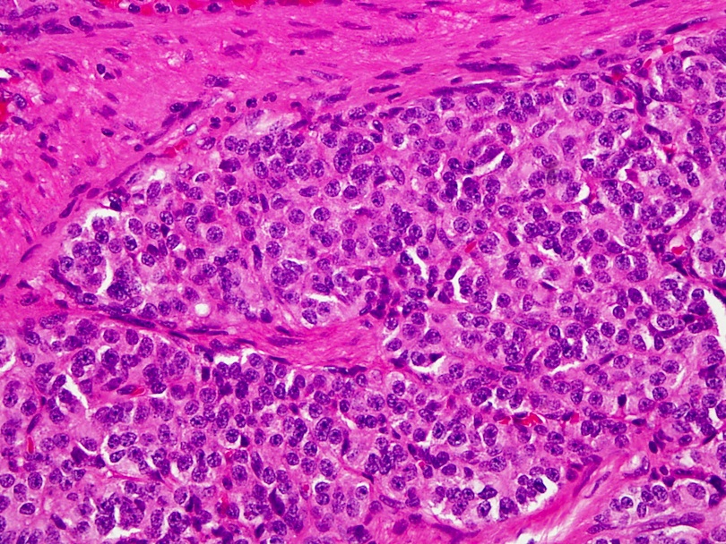 Hội chứng carcinoid có nguy hiểm?