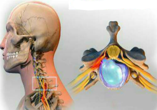 Thoát vị đĩa đệm cột sống cổ chèn ép rễ thần kinh gây đau lan xuống tay.