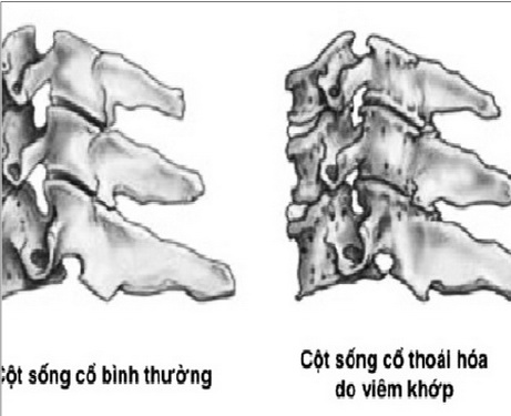 Thoát vị đĩa đệm cột sống cổ chèn ép rễ thần kinh gây đau lan xuống tay.