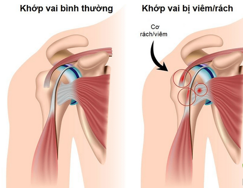 Viêm quanh khớp vai nếu điều trị không đúng có thể dẫn đến cứng khớp vai...