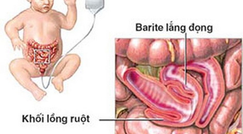 Lồng ruột - Một nguyên nhân gây đau bụng ở trẻ em.