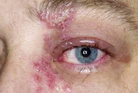 Virut Herpes gây viêm nhiễm trên mắt.