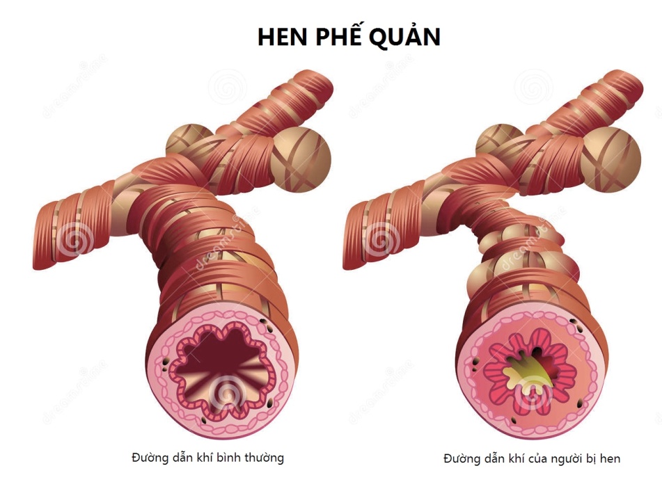 Ở người bệnh hen khi không gắng sức đã khó thở thì khi QHTD càng khó thở hơn do thiếu ôxy.