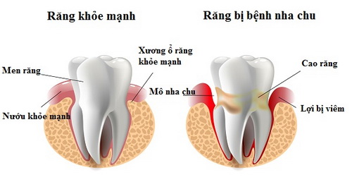 Răng bị bệnh nha chu là nguyên nhân gây hôi miệng, làm mất răng, ảnh hưởng đến sức khỏe người cao tuổi.