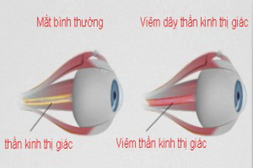 Viêm dây thần kinh thị giác là một nguyên nhân giảm thị lực.