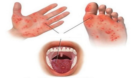 Các nốt ban phỏng nước trên da ở trẻ mắc bệnh tay - chân - miệng.