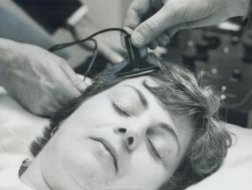 Một bệnh nhân trầm cảm được điều trị bằng ECT tại Toronto, Canada năm 1976.