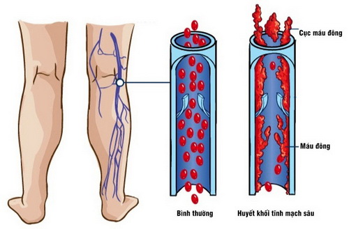 Với đặc tính chống huyết khối khiến nghệ trở nên nguy hiểm khi kết hợp với thuốc làm loãng máu.