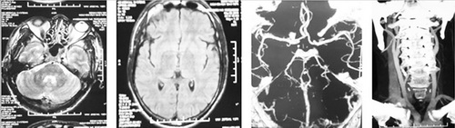 Hình ảnh chụp MRI và CTA của bệnh nhân Nguyễn Huy B không thấy bất thường. Ảnh: BVCC