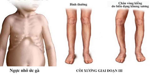 Trẻ bị còi xương do thiếu vitamin D.