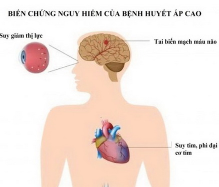 Cần lựa chọn một biện pháp trị tăng huyết áp tối ưu để phòng ngừa các biến chứng do tăng huyết áp gây ra.