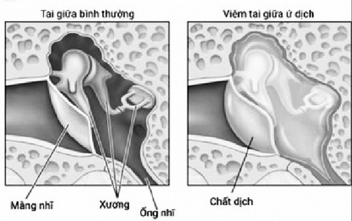 Viêm tai giữa ứ dịch có thể gây nhiều biến chứng.